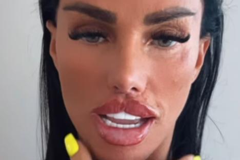 Katie Price reveals the results of her HUGE ‘Butterfly’ lips after getting MORE filler