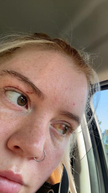 Close-up of a person's face showing injuries around the eyes.