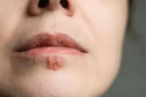 Cold sore treatment could ‘slash risk of developing Alzheimer’s by 17%’, say scientists