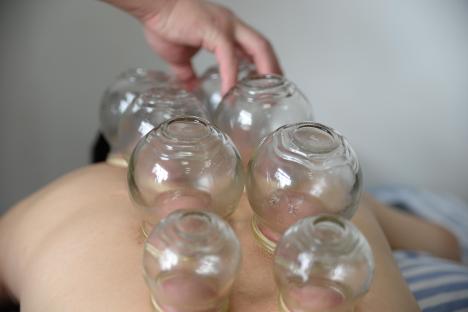 Cupping therapy being applied to a person's back.