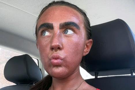 Tan fan, 20, warns others to not over-do it as she shows off shocking damage after just 15 minutes on a sunbed