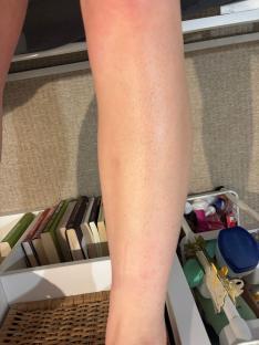 I tried 5 buys to get rid of my strawberry legs this summer, one stung like a B**** and turned me & my bath orange
